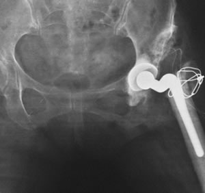 hip implant disconected xray