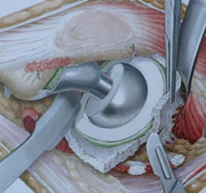 hip revision