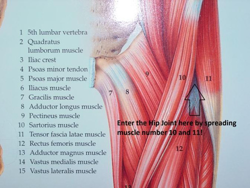 Movement Restrictions After hip Replacement