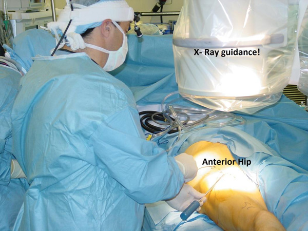 Anterior Hip Replacement