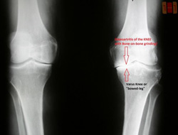8 Signs You Might Need a Total Knee Replacement: Is it Right for You?
