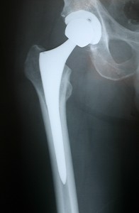 Xray of a Longer Stem Cementless Total Hip Replacement, which can be used in revision surgereries.