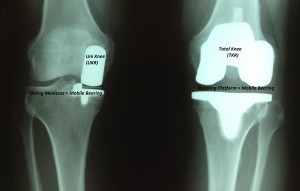 Mobile Bearing Uni Knee and Rotating Platform Total Knee in the same patient.