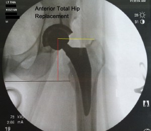 The anterior hip replacement procedure is very accurate because it is checked under real time Xray
