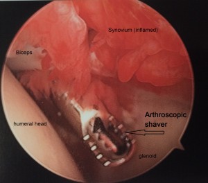 We can work inside of the joint to repair labral tears and debride synovitis.