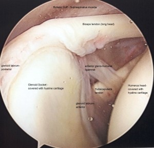 The rotator cuff can be repaired arthroscopically from the inside through tiny portals.