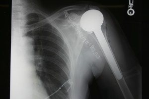 Traditional shoulder replacement with a humerus and glenoid (socket) component