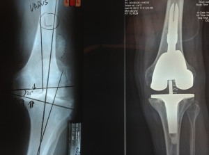 Before and After a Total Knee Arthroplasty