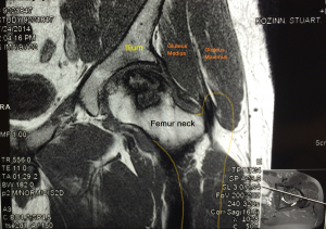 Avascular necrosis of the hip looks like a "dark" spot on hip MRI. It is dead bone.