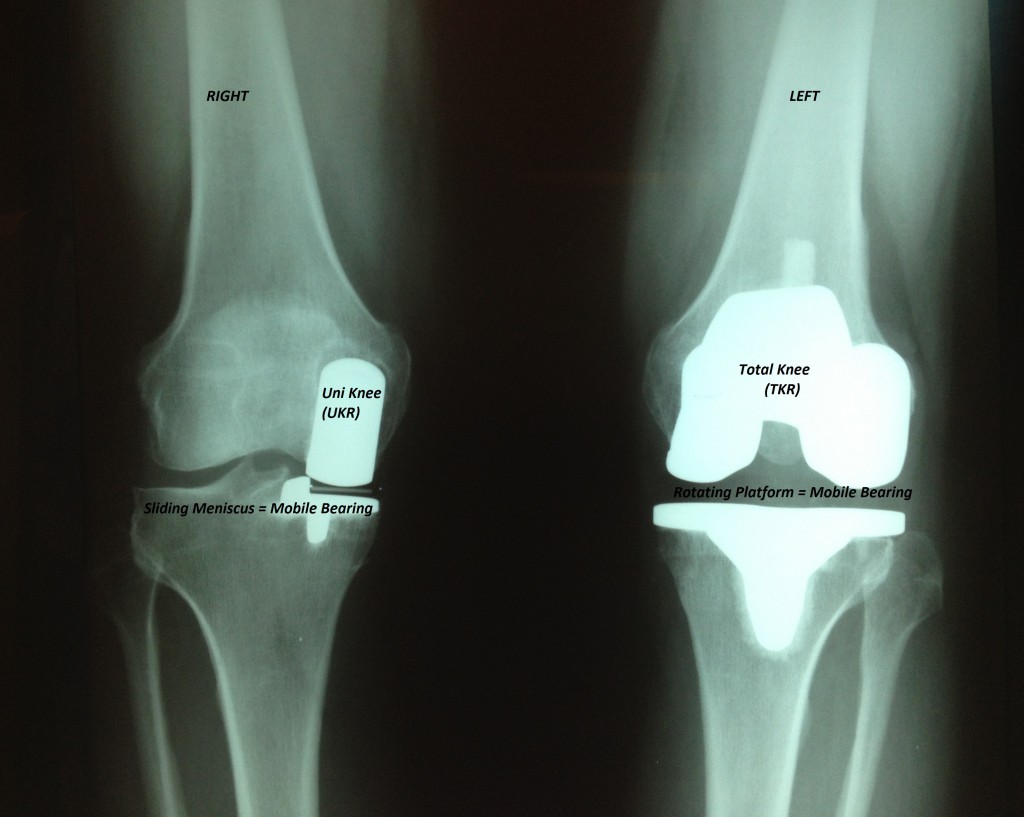 research article knee replacements