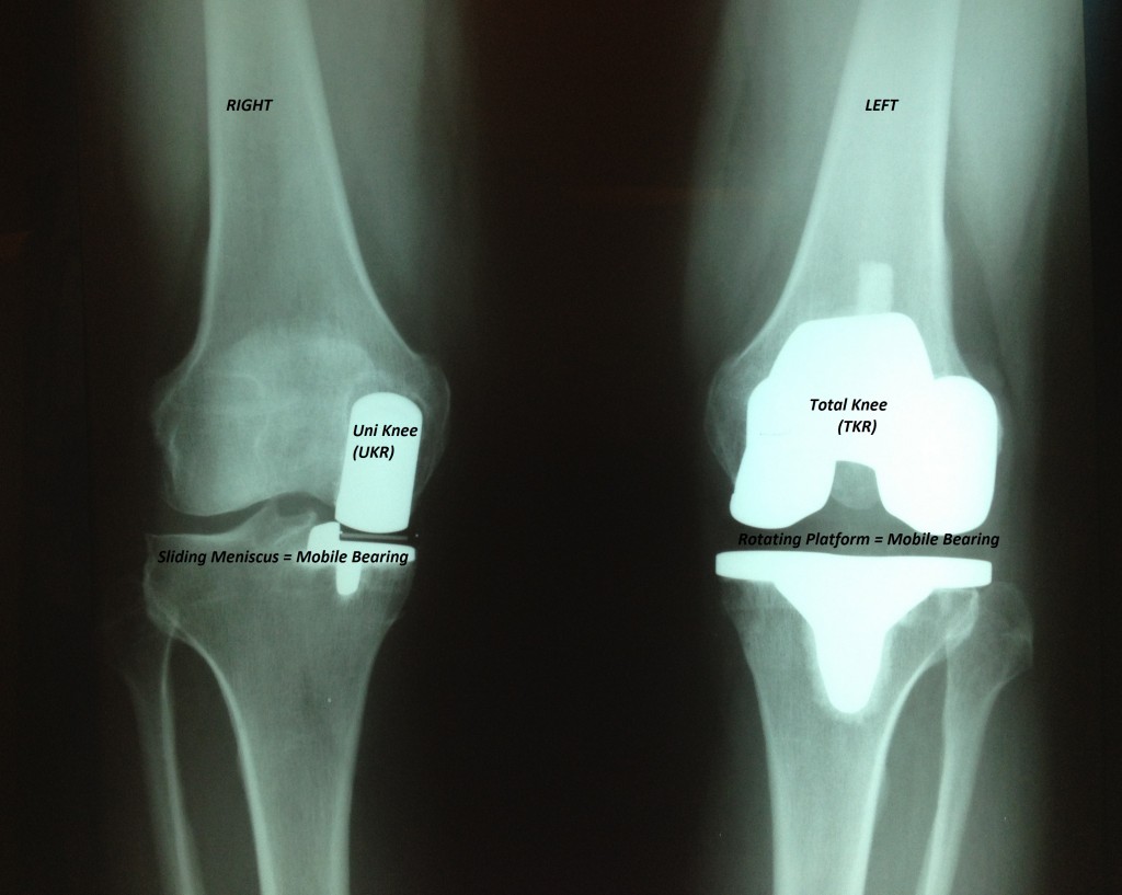 Advances in Knee Replacement Scottsdale Joint Center