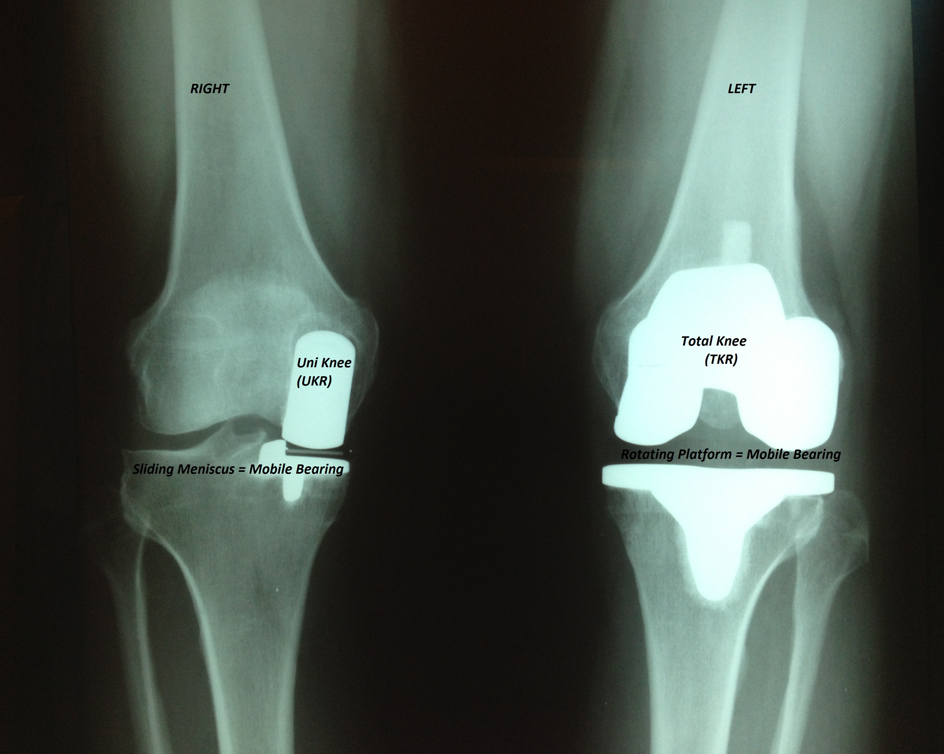 Advances in Knee Replacement.