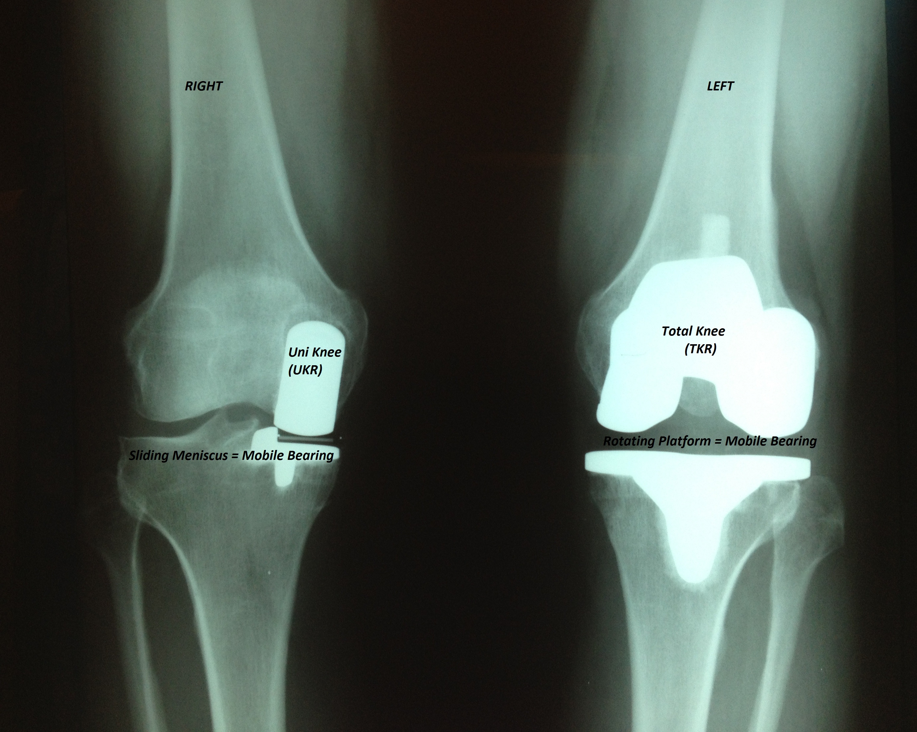 Playing Tennis After Knee Replacement or Hip Replacement