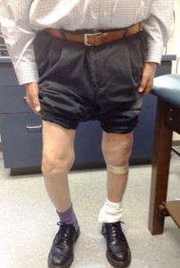 Before and After Total Knee Arthroplasty - the left knee has been replaced ( and straightened) !